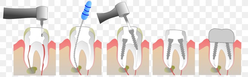 Root Canal Endodontic Therapy Crown Tooth Dentist, PNG, 1600x500px, Root Canal, Bridge, Crown, Cutlery, Dental Implant Download Free