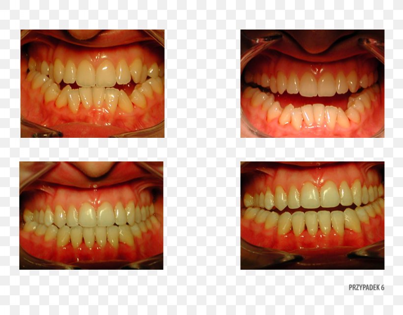 Close-up Tooth, PNG, 1024x800px, Closeup, Close Up, Jaw, Lip, Mouth Download Free