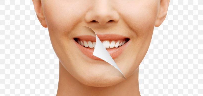 Tooth Whitening Dentistry Human Tooth Bleach, PNG, 1495x710px, Tooth Whitening, Bleach, Cheek, Chin, Close Up Download Free