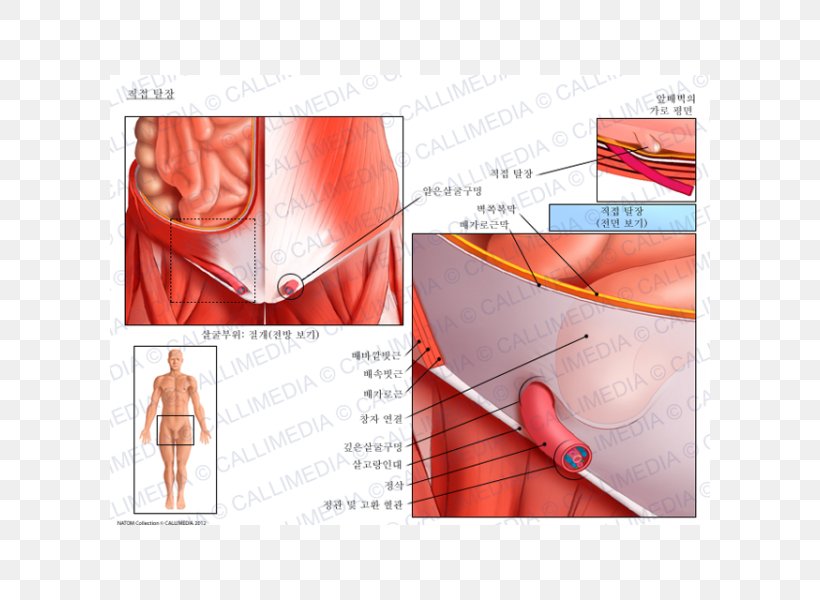Inguinal Hernia Abdominal External Oblique Muscle Inguinal Canal Anatomy, PNG, 600x600px, Watercolor, Cartoon, Flower, Frame, Heart Download Free