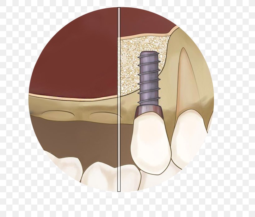 Sinus Lift Maxillary Sinus Dental Implant, PNG, 692x700px, Sinus, Anatomy, Bone, Com, Dental Implant Download Free