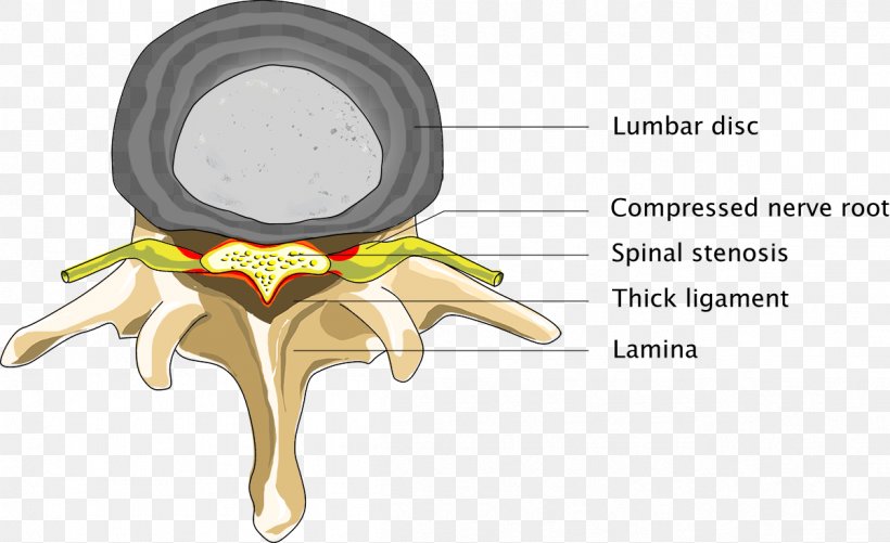 Spinal Disc Herniation Spinal Cord Spinal Stenosis Back Pain, PNG, 1201x734px, Watercolor, Cartoon, Flower, Frame, Heart Download Free