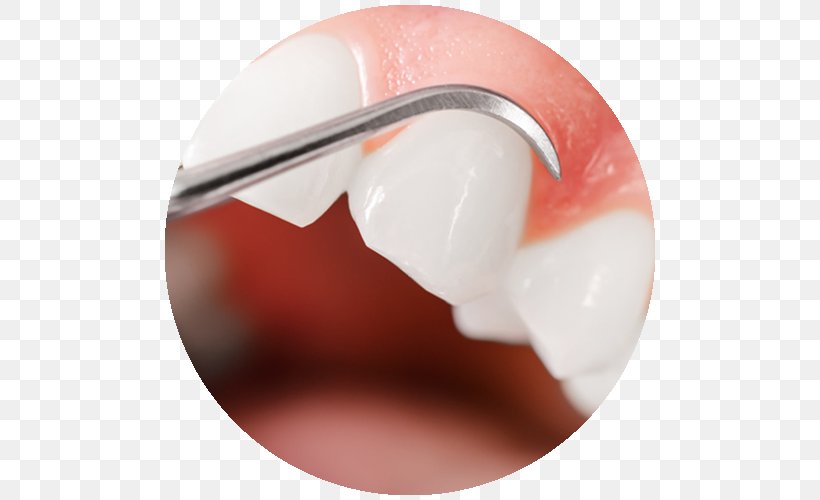 Gums Periodontal Disease Gingival Graft Swelling Gingivitis, PNG, 500x500px, Gums, Dentist, Dentistry, Disease, Eating Download Free