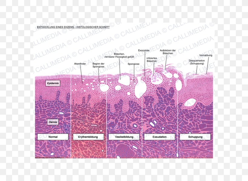 Histology Eczema Dermatitis Skin Corte Histológico, PNG, 600x600px, Histology, Anatomy, Area, Brand, Dermatitis Download Free