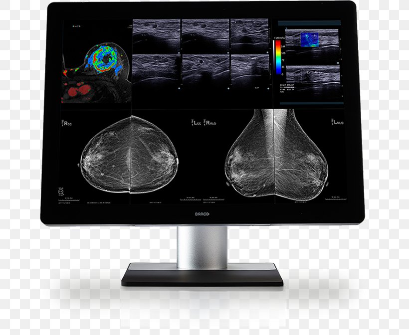 Computer Monitors Barco Digital Mammography Medical Imaging, PNG, 750x672px, Computer Monitors, Barco, Breast Cancer, Digital Mammography, Display Device Download Free