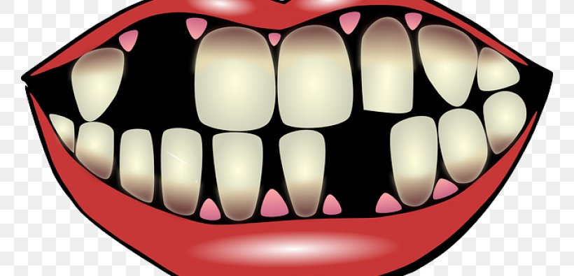 Dentistry Dental Implant Tooth, PNG, 760x395px, Watercolor, Cartoon, Flower, Frame, Heart Download Free