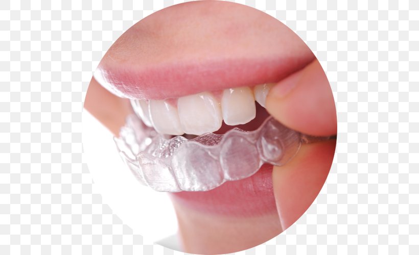 Clear Aligners Dental Braces Dentistry Orthodontics Retainer, PNG, 500x500px, Clear Aligners, Cosmetic Dentistry, Crown, Dental Braces, Dental Implant Download Free