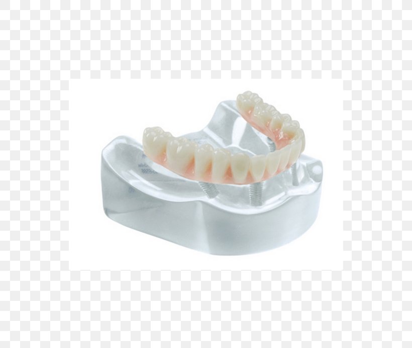 Tooth Bridge Dental Implant Specialty Salvin Dental Specialties, PNG, 546x694px, Tooth, Biomaterial, Bone Fracture, Bridge, Crown Download Free