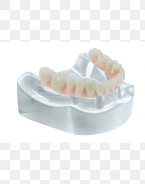 Bridge - Tooth Bridge Dental Implant Specialty Salvin Dental Specialties PNG