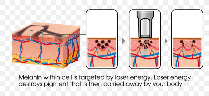 Tattoo Removal Nd:YAG Laser Détatouage Laser, PNG, 800x378px, Tattoo Removal, Brand, Complexion, Freckle, Gift Download Free