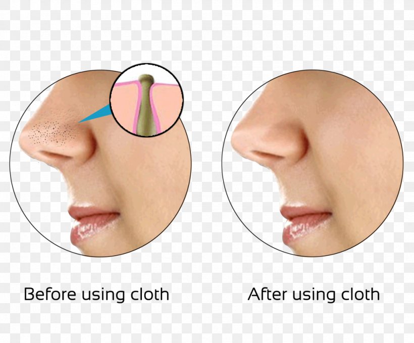 Comedo Skin Nose Exfoliation Pimple, PNG, 1024x848px, Comedo, Acne, Cheek, Chin, Cosmetics Download Free