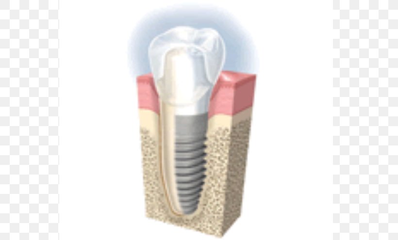 Dental Implant Cosmetic Dentistry Tooth Loss, PNG, 657x495px, Dental Implant, Bridge, Brush, Cosmetic Dentistry, Crown Download Free