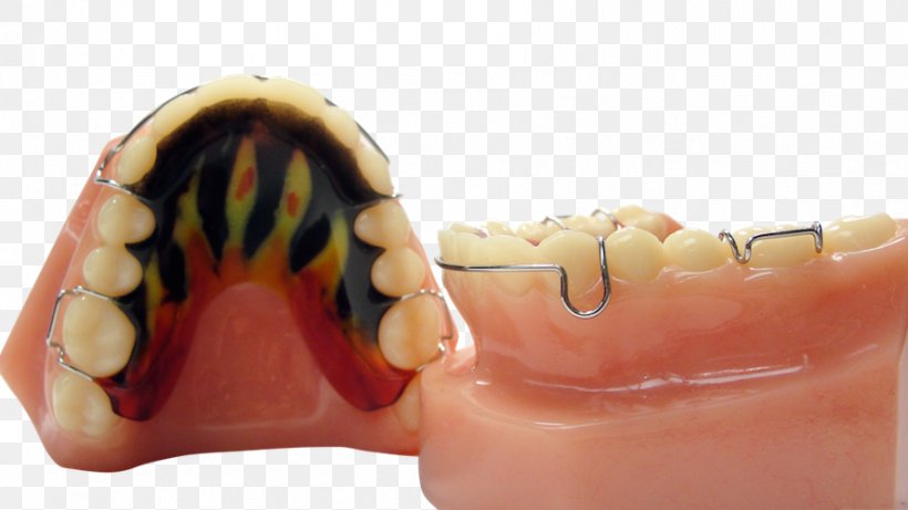 Tooth Jaw Retainer Orthodontics ROA, PNG, 889x500px, Tooth, Dentures, Finger, Health Beauty, Jaw Download Free