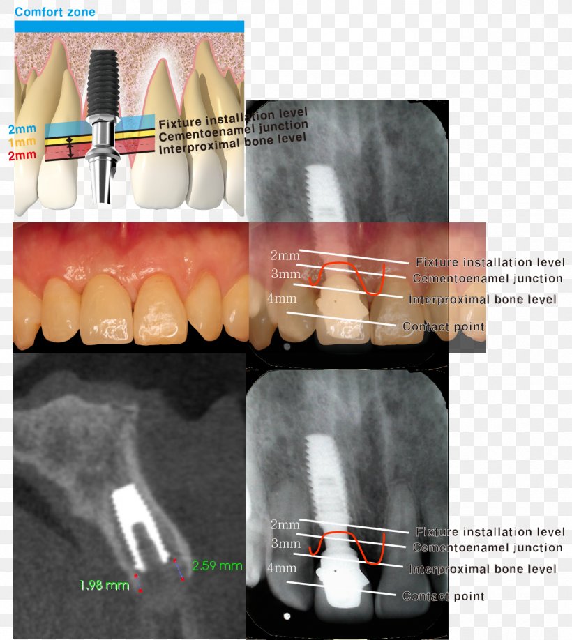 Dental Implant Cementoenamel Junction Tooth Dentistry Maxillary Sinus, PNG, 1269x1422px, Dental Implant, Abutment, Anatomy, Cementum, Crown Download Free