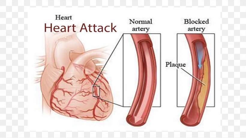 Coronary Artery Disease Cardiovascular Disease Myocardial Infarction Cardiology, PNG, 1920x1080px, Watercolor, Cartoon, Flower, Frame, Heart Download Free