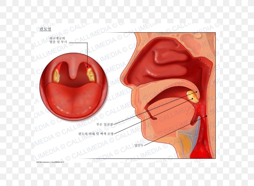 Tonsillitis Otorhinolaryngology Oropharynx Oropharyngeal Cancer, PNG, 600x600px, Tonsillitis, Anatomy, Disease, Ear, Heart Download Free