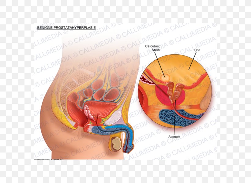 benigne prostatahyperplasie( bph))