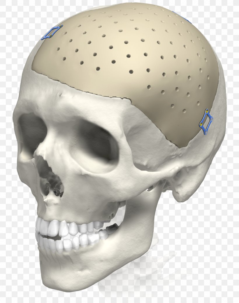 Пластика дефектов черепа (краниопластика). Титановые импланты для черепа. Bone head