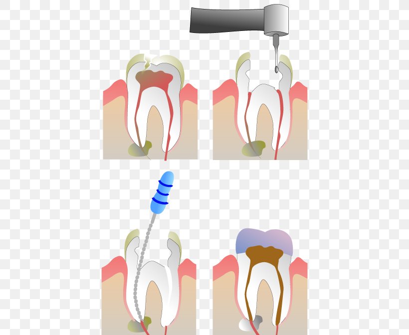Endodontic Therapy Root Canal Dentistry, PNG, 538x672px, Watercolor, Cartoon, Flower, Frame, Heart Download Free