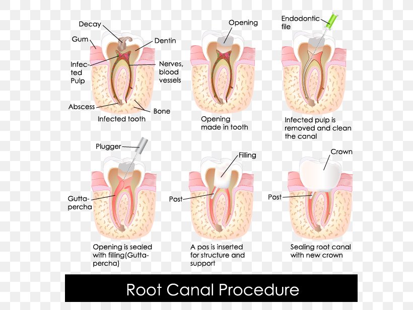 Endodontic Therapy Root Canal Dentistry Crown, PNG, 647x616px, Watercolor, Cartoon, Flower, Frame, Heart Download Free