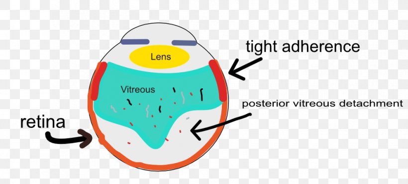 Posterior Vitreous Detachment Floater Vitreous Body Retina Photopsia, PNG, 993x450px, Watercolor, Cartoon, Flower, Frame, Heart Download Free