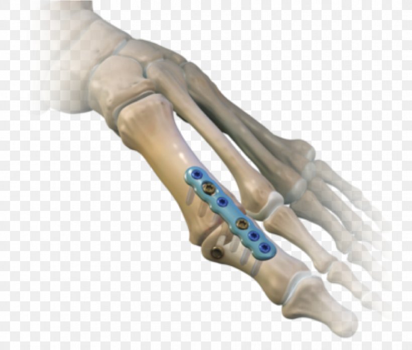 Arthrodesis Metatarsophalangeal Joints Surgery Hallux Rigidus, PNG, 912x776px, Arthrodesis, Arm, Arthritis, Bone, Finger Download Free