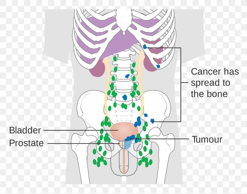 Prostate Cancer Lymph Node Metastasis Prostate-specific Antigen, PNG, 1600x1254px, Watercolor, Cartoon, Flower, Frame, Heart Download Free