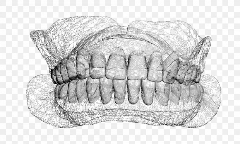 Overdentures Sketch Veneer, PNG, 2000x1200px, 3d Printing, 3d Scanning, Dentures, Dental Implant, Dental Laboratory Download Free