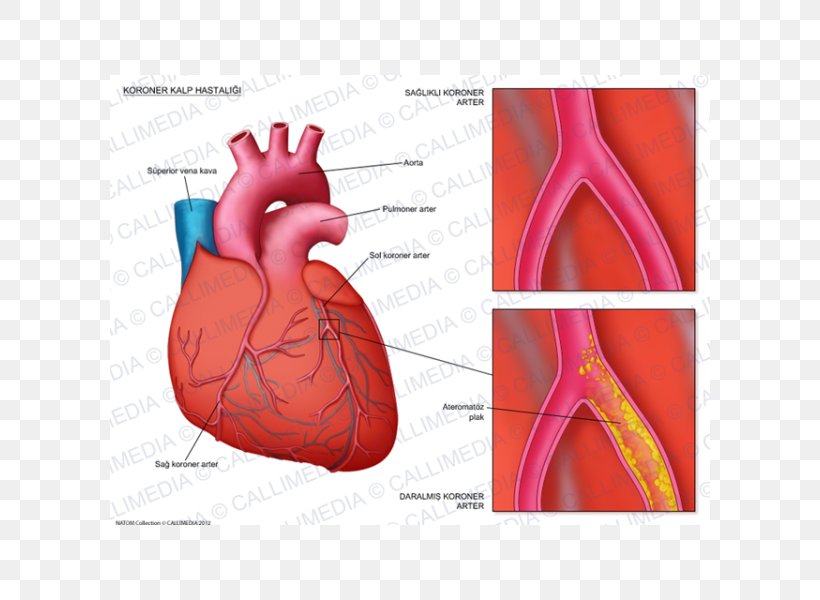Coronary Artery Disease Coronary Arteries Cardiology Cardiovascular Disease, PNG, 600x600px, Watercolor, Cartoon, Flower, Frame, Heart Download Free