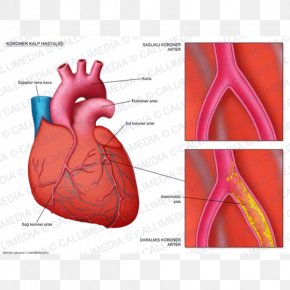Heart - Coronary Artery Disease Coronary Arteries Cardiology Cardiovascular Disease PNG