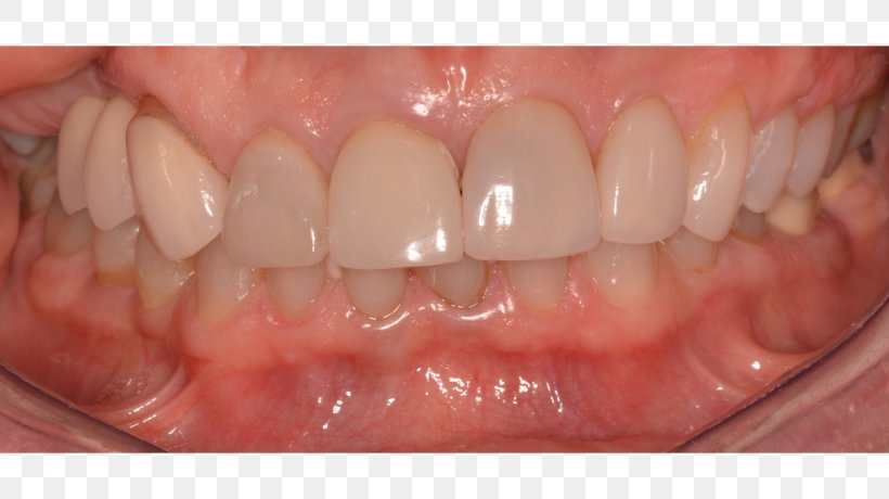 Human Tooth Cosmetic Dentistry Veneer, PNG, 1024x575px, Tooth, Ceramic, Chin, Close Up, Cosmetic Dentistry Download Free