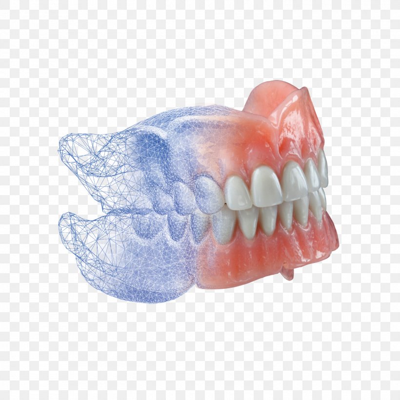 Dentures Dentistry Dental Laboratory Dental Implant, PNG, 1500x1500px, Dentures, Avadent, Bridge, Cadcam Dentistry, Cosmetic Dentistry Download Free