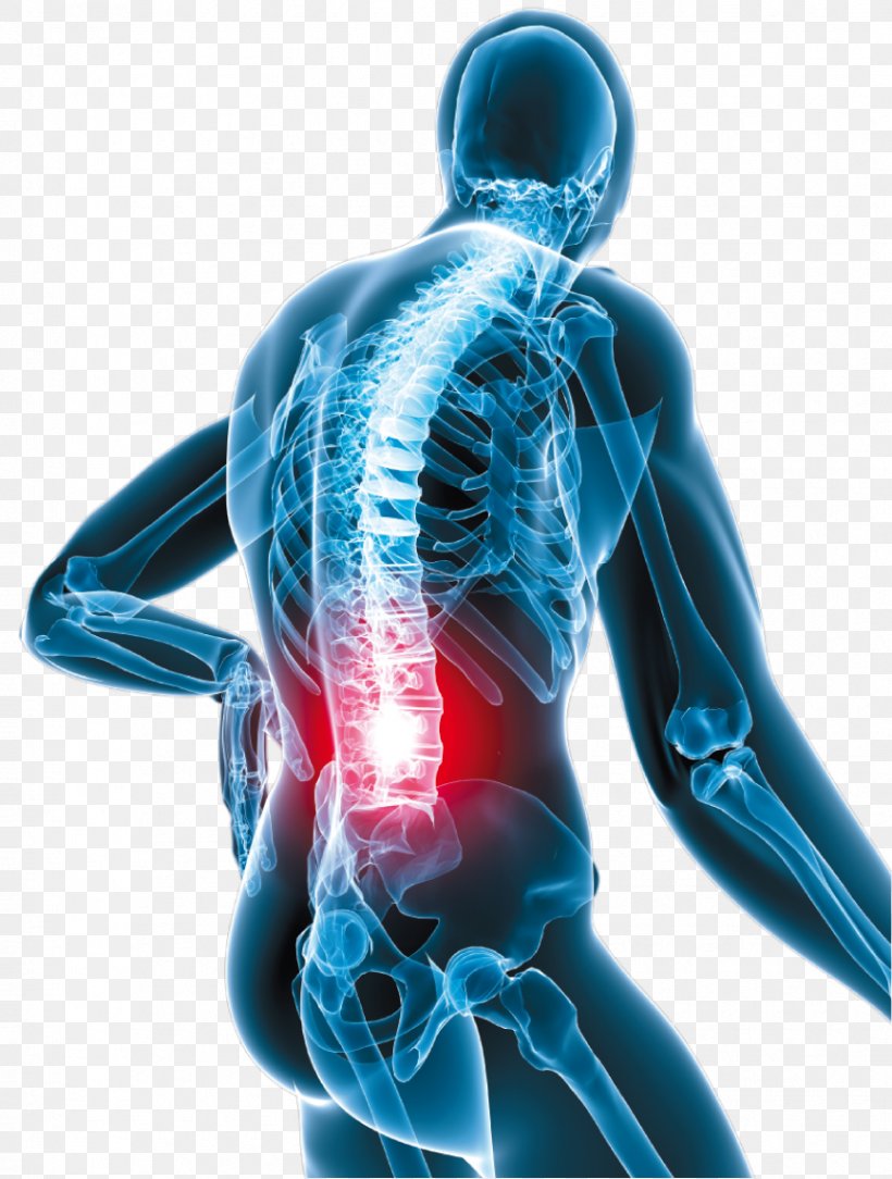 Low Back Pain Neck Pain Oxycodone Human Back, PNG, 867x1147px, Back Pain, Disease, Electric Blue, Human Back, Injury Download Free