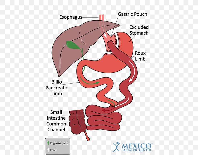 Gastric Bypass Surgery Bariatric Surgery Sleeve Gastrectomy Gastric Balloon, PNG, 450x640px, Watercolor, Cartoon, Flower, Frame, Heart Download Free