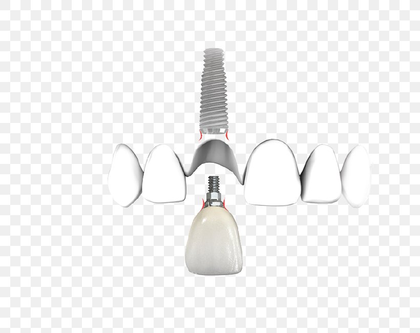 Dentistry Dental Implant Product Design, PNG, 650x650px, Dentist, Aesthetics, Dental Implant, Dentistry, Experience Download Free
