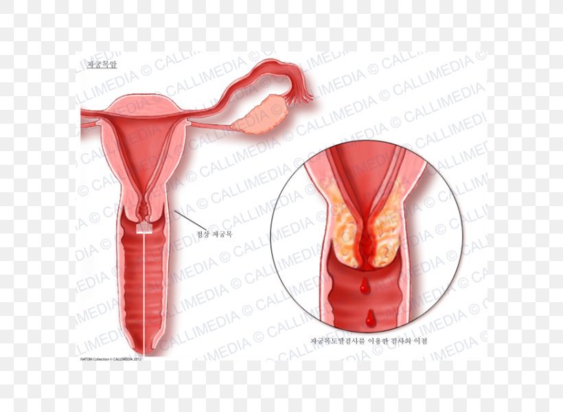 Cervical Cancer Uterine Cancer Cervix Uterus, PNG, 600x600px, Cervical Cancer, Breast Cancer, Cancer, Carcinoma, Carcinoma In Situ Download Free