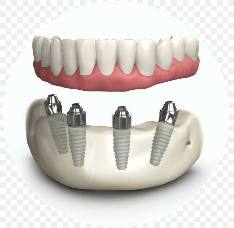 Tooth Dentures Dental Implant Dentistry, PNG, 800x800px, Tooth, Bone Grafting, Crown Lengthening, Dental Implant, Dental Laboratory Download Free