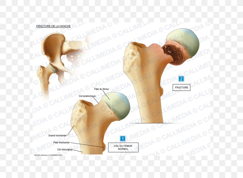 Hip Fracture Shoulder Bone Fracture Femur, PNG, 600x600px, Watercolor, Cartoon, Flower, Frame, Heart Download Free