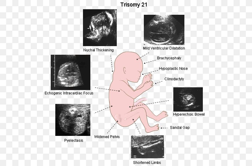 Down Syndrome Ultrasonography Sonographer Fetus, PNG, 572x540px, Watercolor, Cartoon, Flower, Frame, Heart Download Free