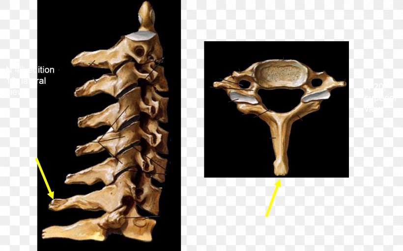 Vertebra Prominens Vertebral Column Cervical Vertebrae Sacrum, PNG, 1461x913px, Vertebra Prominens, Anatomy, Articular Processes, Axial Skeleton, Bone Download Free