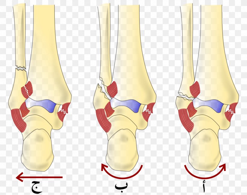 Danis–Weber Classification Ankle Fracture Lauge-Hansen Classification Bone Fracture Malleolus, PNG, 1280x1013px, Ankle Fracture, Ankle, Arm, Avulsion Fracture, Bone Fracture Download Free
