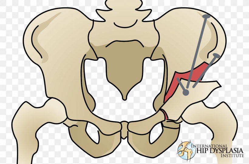 Finger Osteotomy Hip Dysplasia Surgery, PNG, 1313x869px, Watercolor, Cartoon, Flower, Frame, Heart Download Free