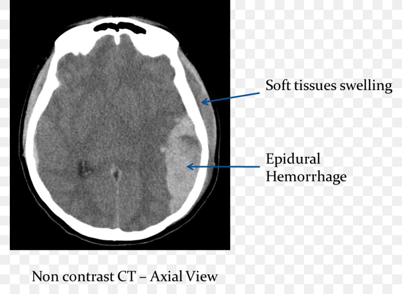 Computed Tomography Of The Head Brain Epidural Hematoma Cerebral Hemorrhage, PNG, 1025x750px, Watercolor, Cartoon, Flower, Frame, Heart Download Free