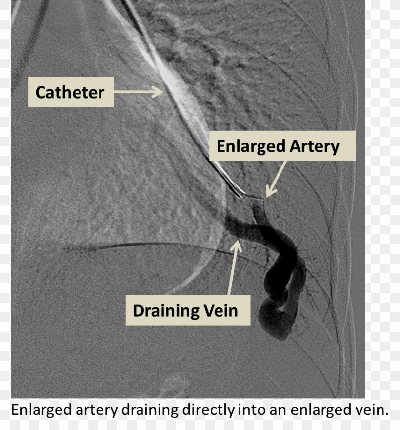 Cerebral Arteriovenous Malformation Lung Embolization Angiography, PNG, 875x941px, Arteriovenous Malformation, Angiography, Artery, Black And White, Disease Download Free