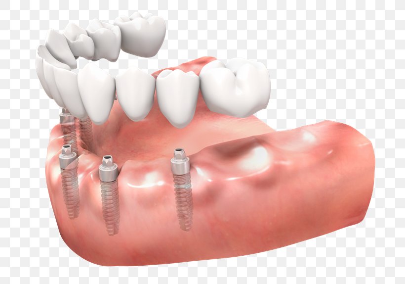 Tooth Dentures Dental Implant Implantology, PNG, 768x574px, Tooth, Bridge, Ceramic, Chin, Cosmetic Dentistry Download Free