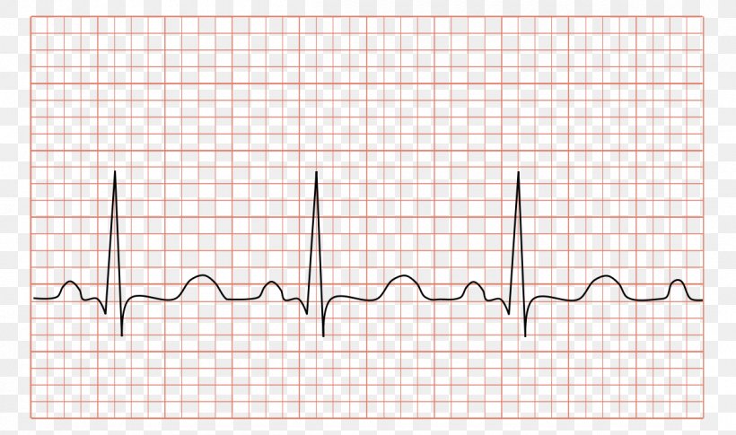 Electrocardiography Tachycardia Heart Rate Cardiology, PNG, 1200x711px, Watercolor, Cartoon, Flower, Frame, Heart Download Free