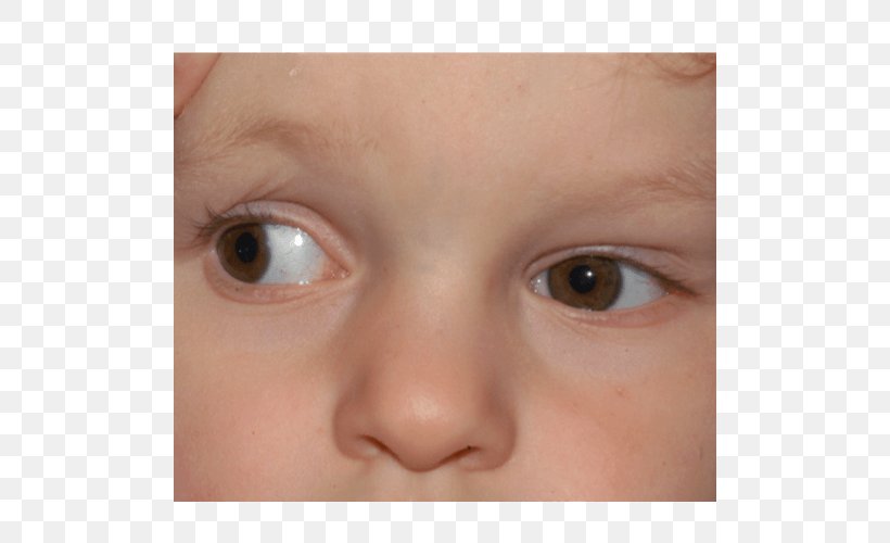 Duane Syndrome Eye Movement Differential Diagnosis, PNG, 500x500px, Syndrome, Cheek, Child, Chin, Close Up Download Free