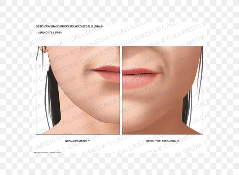 Acromegaly Face Diabetes Mellitus Lip Surgery, PNG, 600x600px, Acromegaly, Cheek, Chin, Cosmetics, Diabetes Download Free