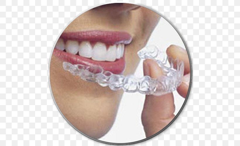 Clear Aligners Dental Braces Orthodontics Dentistry Therapy, PNG, 500x500px, Clear Aligners, Cosmetic Dentistry, Dental Braces, Dental Surgery, Dentist Download Free