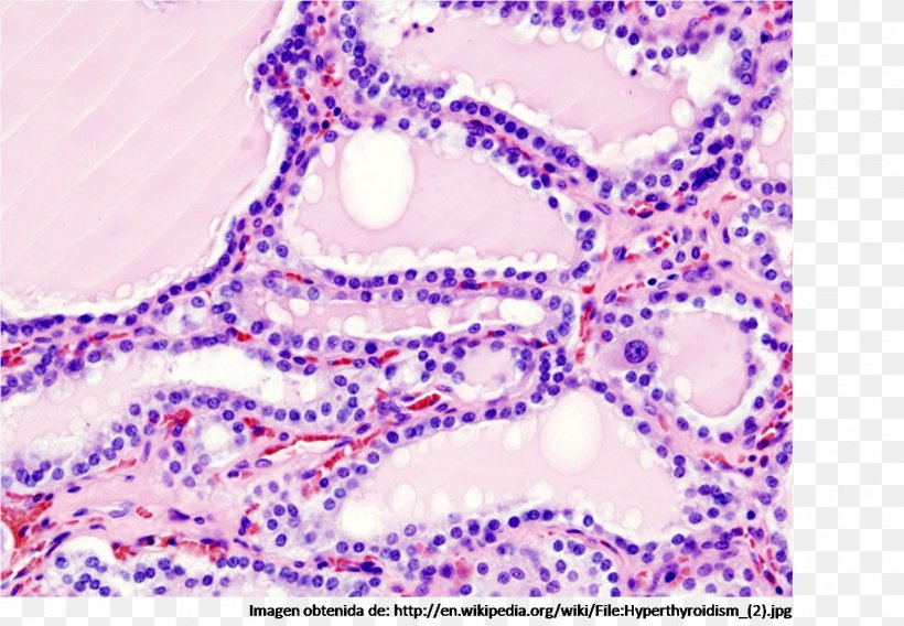 Graves' Disease Hyperthyroidism Biopsy, PNG, 1338x927px, Graves Disease, Area, Autoimmunity, Biopsy, Cancer Download Free